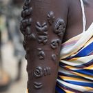 Les cicatrices sont difficiles à décrypter