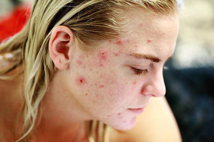 Variole du singe (image d'illustration)