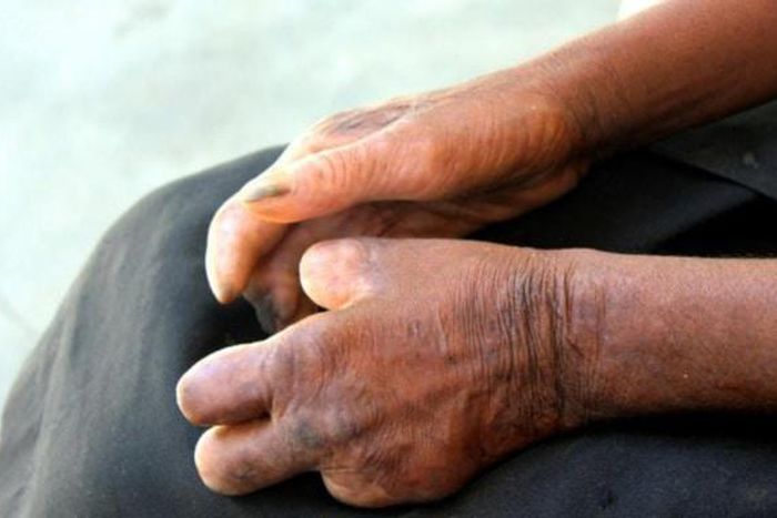 Situation des lepreux