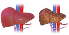 hepatite