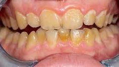 Dents jaunes