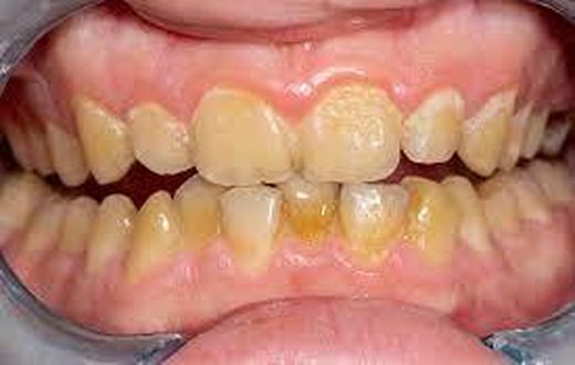 Dents jaunes