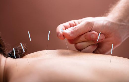 Acupunture  Andrey Popov - Fotoliacom