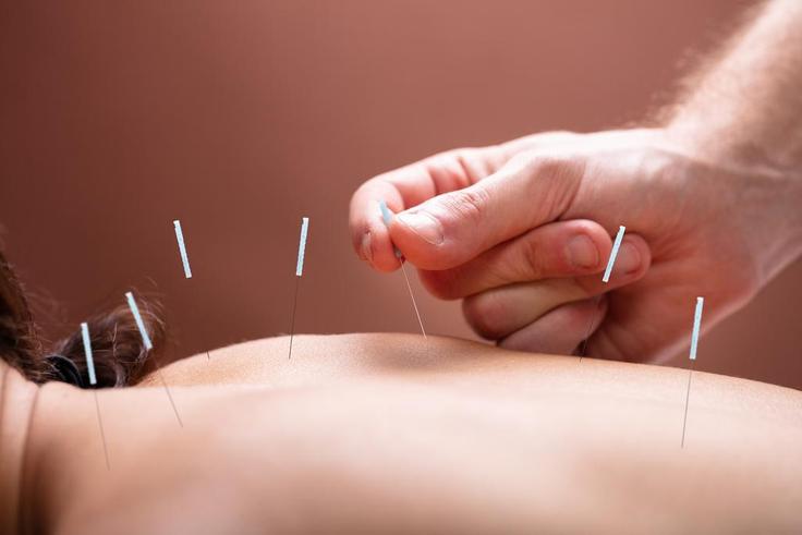 Acupunture  Andrey Popov - Fotoliacom