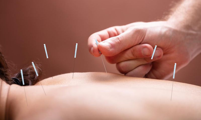 Acupunture  Andrey Popov - Fotoliacom