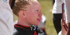 Femme albinos