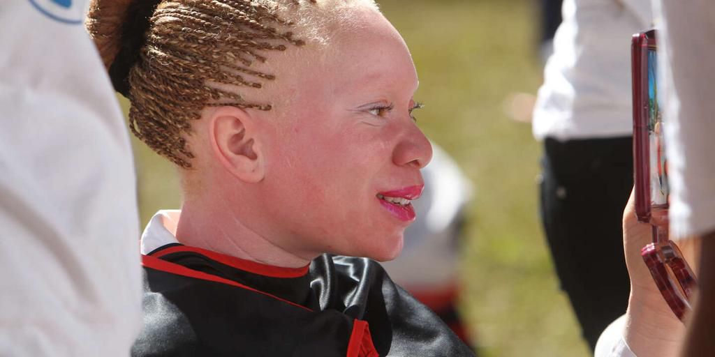 Femme albinos