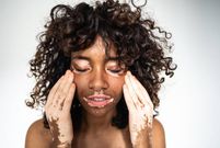 LMD vitiligo palette traitements gallerylarge