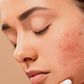 peau acnéique2