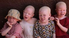 Albinos