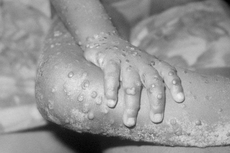 Variole du Singe, éruption cutanée