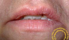 soin-des-levres-abimees