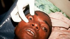 Marburg Virus (Healthnews)