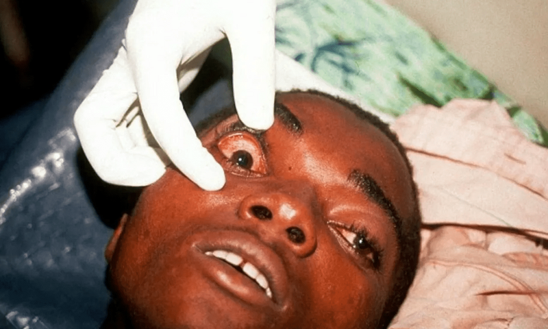 Marburg Virus (Healthnews)