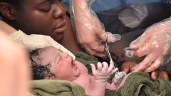 Facts about C-section [istock]