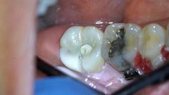 If the cavity is under a crown, the crown has to go.