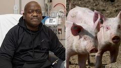 Le-premier-beneficiaire-du-rein-de-porc-genetiquement-modifie-est