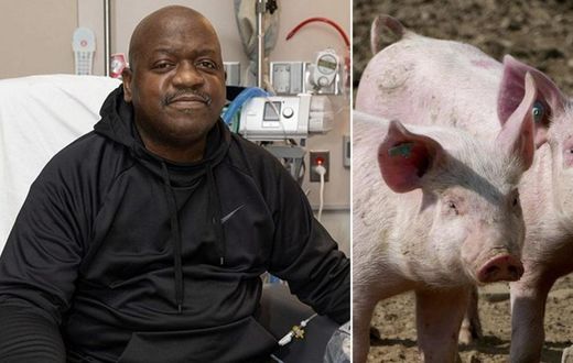 Le-premier-beneficiaire-du-rein-de-porc-genetiquement-modifie-est