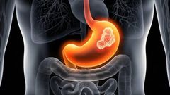 cancer-de-l'estomac-2