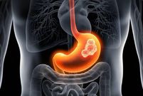 cancer-de-l'estomac-2