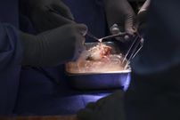 operation du receveur de la première greffe de rein de porc génétiquement modifié