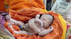 Inde - une femme accouche d'un enfant avec quatre bras et quatre jambes (2)