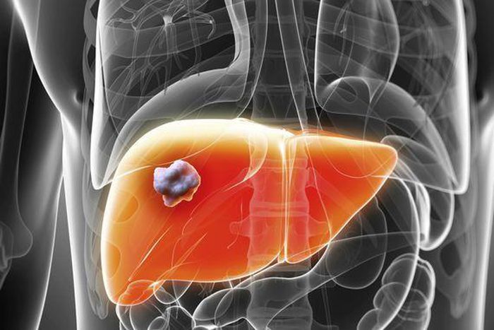 Cancer du foie