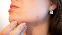 irritation-peau