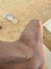 Un membre de la délégation victime de piqures de moustiques