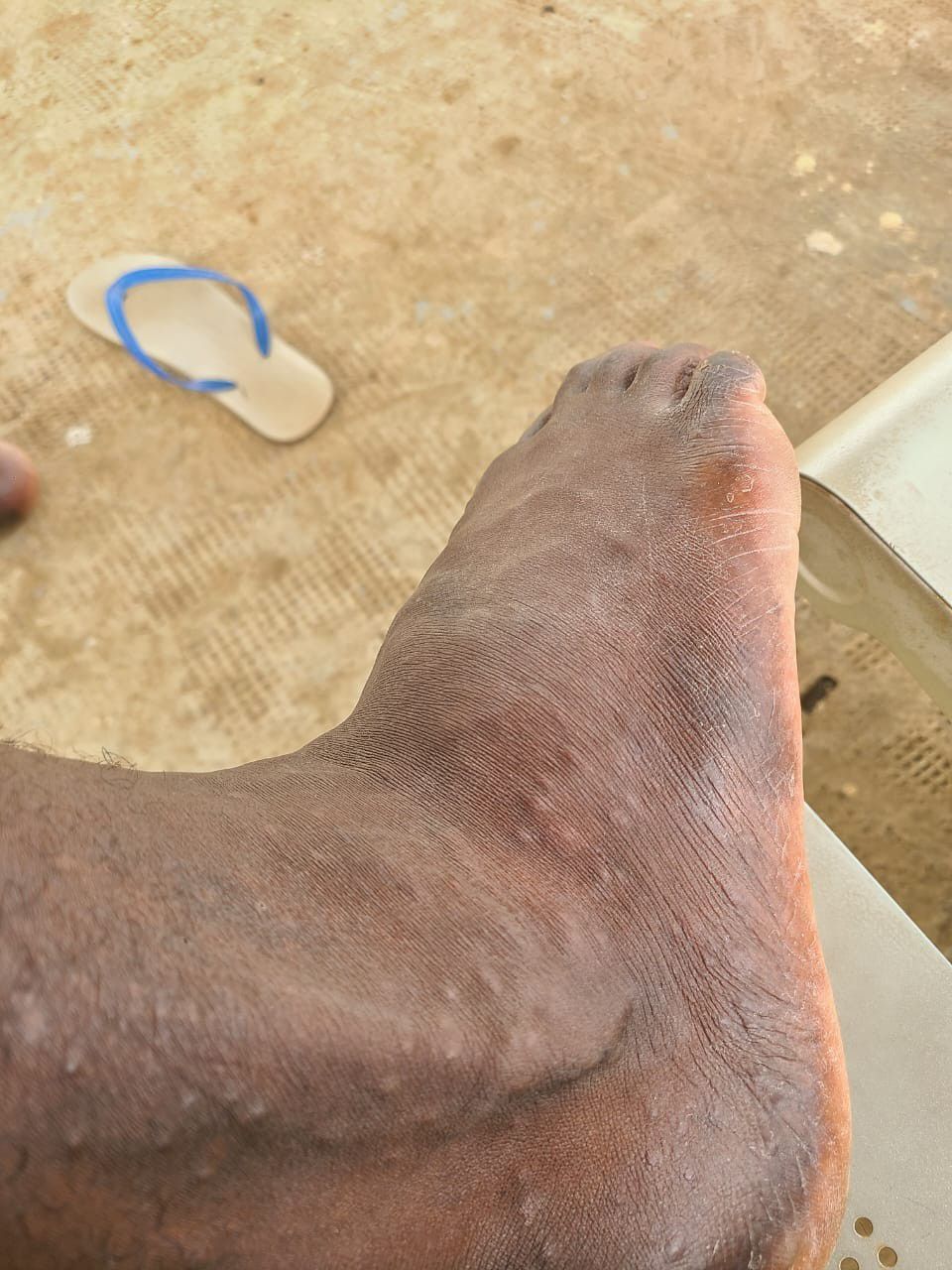 Un membre de la délégation victime de piqures de moustiques