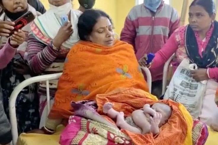 Inde - une femme accouche d'un enfant avec quatre bras et quatre jambes (1)