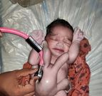 La naissance d'un bébé avec quatre bras et quatre jambes célébrée en Inde