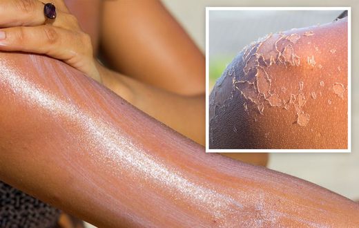Astuces-pour-éviter-la-peau-qui-pèle