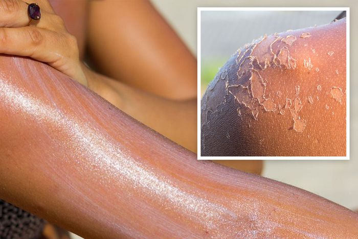 Astuces-pour-éviter-la-peau-qui-pèle