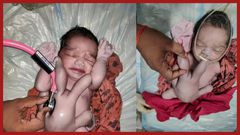 Un-bébé-naît-avec-quatre-bras-et-quatre-jambes