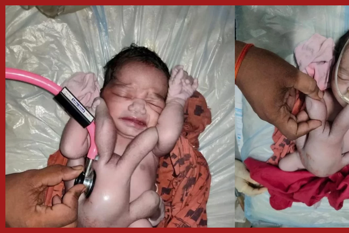 Un-bébé-naît-avec-quatre-bras-et-quatre-jambes