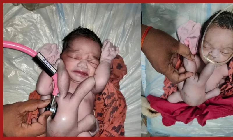 Un-bébé-naît-avec-quatre-bras-et-quatre-jambes