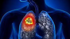 cancer-du-poumon 66298382 m-open-graph