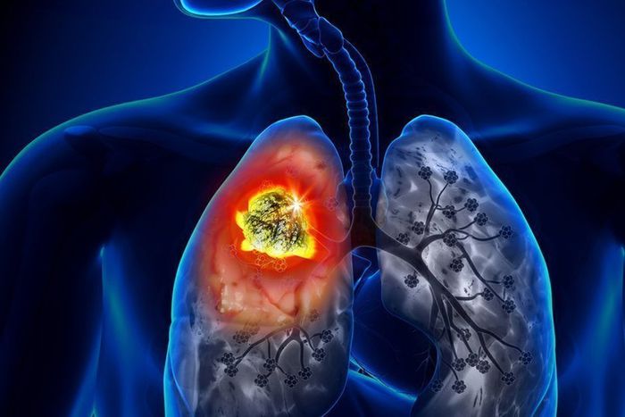 cancer-du-poumon 66298382 m-open-graph