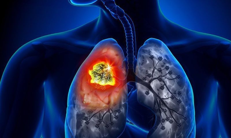 cancer-du-poumon 66298382 m-open-graph