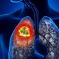 cancer-du-poumon 66298382 m-open-graph
