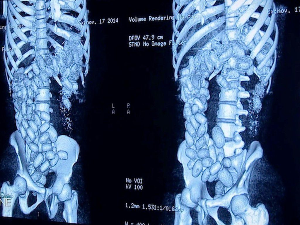 Radiographie d'une mule transportant des boulettes de stupéfiants dans son estomac