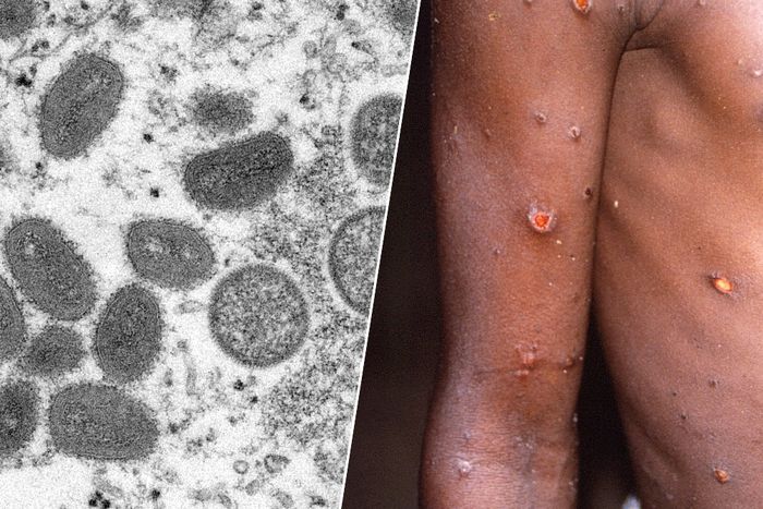Variole du singe en Europe