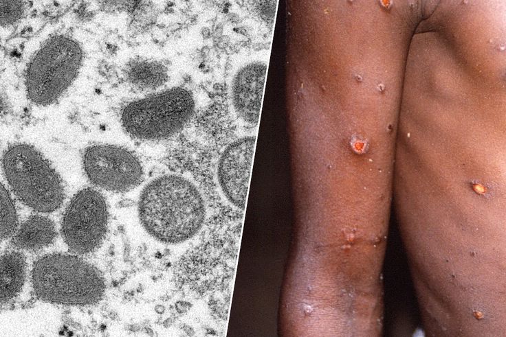 Variole du singe en Europe