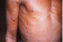 Les effets de la variole du singe