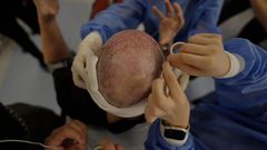 Spencer Macnaughton during his hair transplant in Istanbul TurkeyKenny Wassus/Business Insider