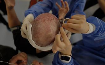 Spencer Macnaughton during his hair transplant in Istanbul TurkeyKenny Wassus/Business Insider