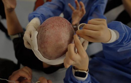 Spencer Macnaughton during his hair transplant in Istanbul TurkeyKenny Wassus/Business Insider