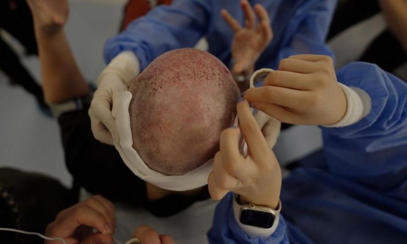 Spencer Macnaughton during his hair transplant in Istanbul TurkeyKenny Wassus/Business Insider