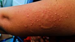 Monkeypox